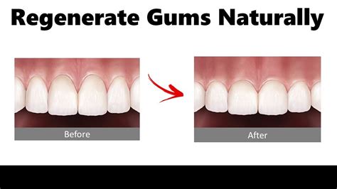 gum tissue regeneration henderson